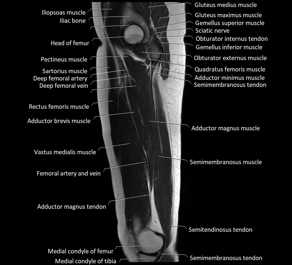 Thigh sagittal cross sectional anatomy MRI 3T image 13.webp